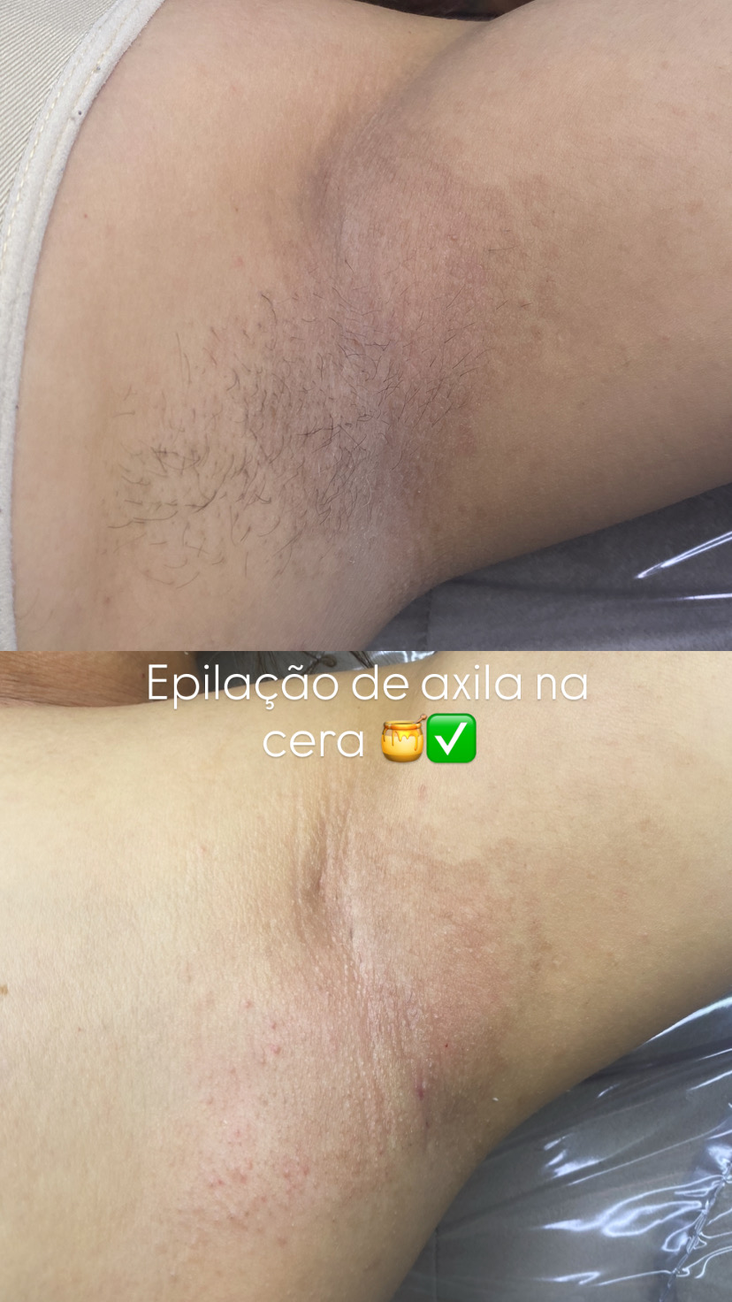 Epilação: Axila